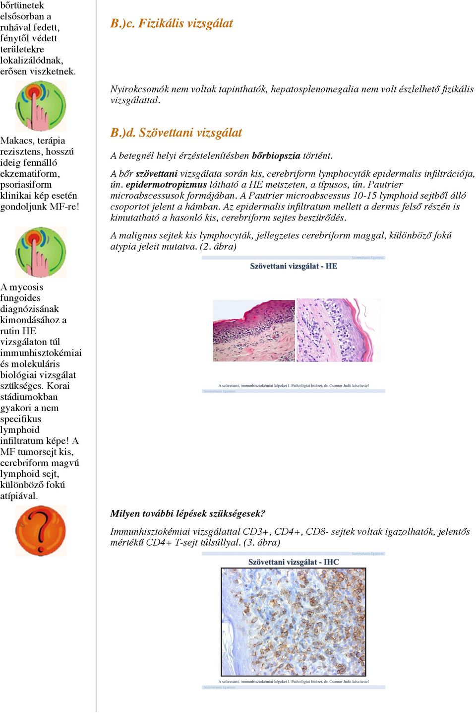 Makacs, terápia rezisztens, hosszú ideig fennálló ekzematiform, psoriasiform klinikai kép esetén gondoljunk MF-re! B.)d. Szövettani vizsgálat A betegnél helyi érzéstelenítésben bőrbiopszia történt.