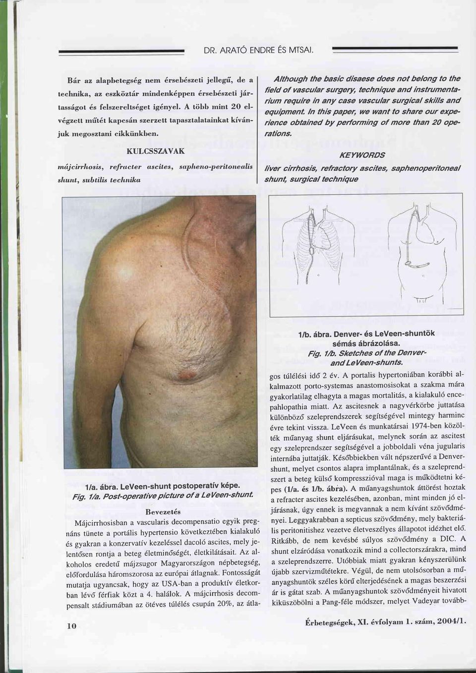 KULCSSZAVAK mäjcirrlrcsß, refructer ascites, suplrcnolteritoneulis slrutrl, sub tilis tecl trüku Although the basic dtbaese does not belong to the field of vascular surgery, technrque and