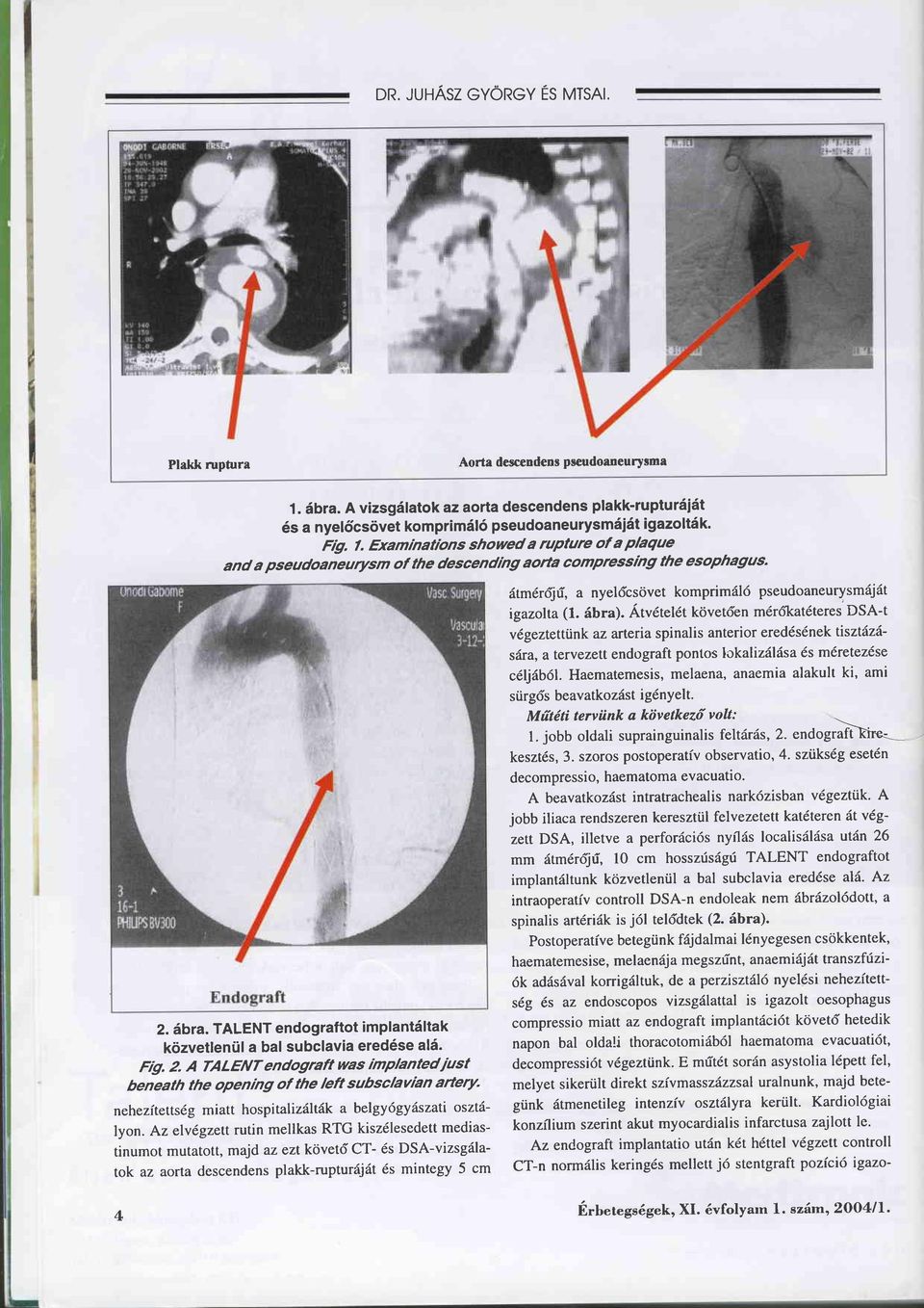 Ätudtel6t követden mdr6katdteres DSA-I vdgeztettünk az arteria spinalis anterior eredds6nek tisztdztsdra, a tervezett endograft pontos lokalizäläsa 6s mdretezdse cdljäb61.