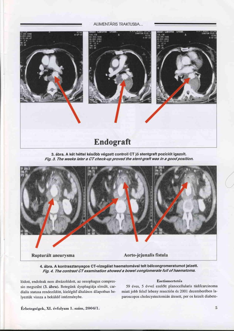 l6dott, endoleak nem äbräzolödott, az oesophagus compressio megszrint (3. äbra).