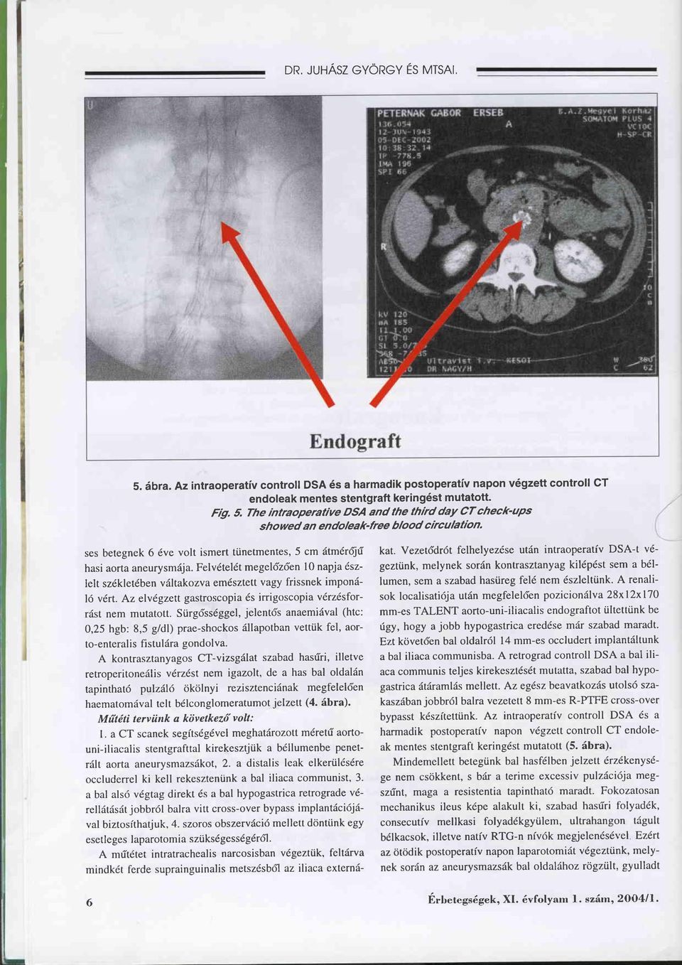 Felv6tel6t megel6z6en l0 napja 6szlelt szdkletdben vältakozva emdsztett vagy frissnek imponälö vdrt. Az elvf,gzett gastroscopia 6s irrigoscopia v6rz6sforräst nem mutatott.