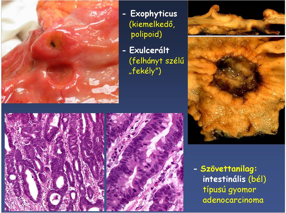 szélű fekély ) - Szövettanilag:
