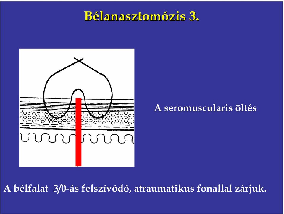 bélfalat 3/0-ás