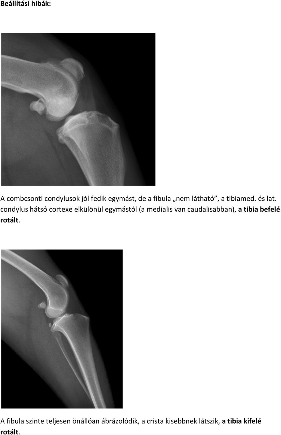 condylus hátsó cortexe elkülönül egymástól (a medialis van caudalisabban),