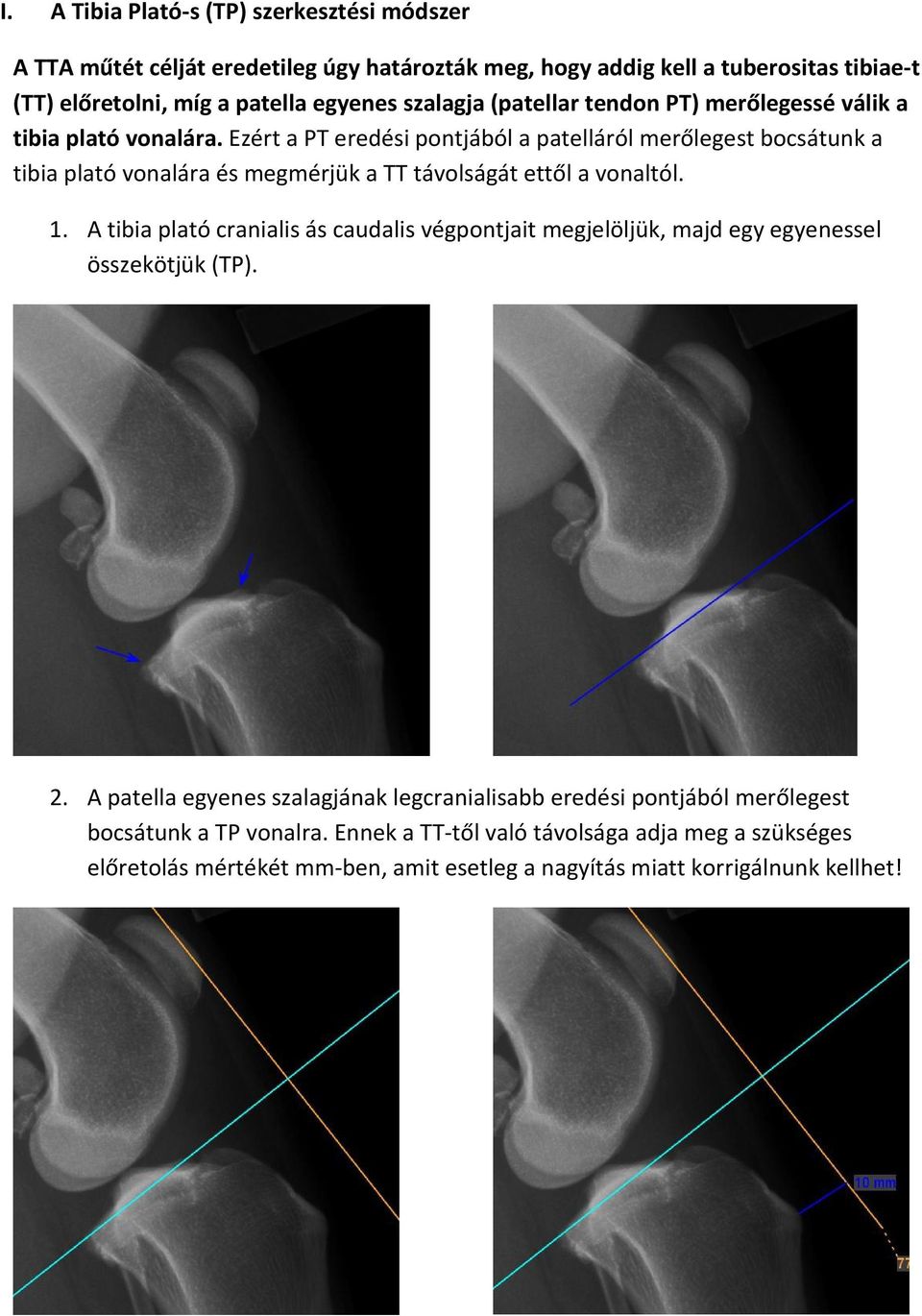 Ezért a PT eredési pontjából a patelláról merőlegest bocsátunk a tibia plató vonalára és megmérjük a TT távolságát ettől a vonaltól. 1.