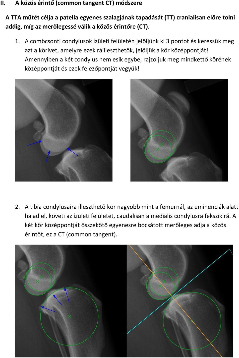 Amennyiben a két condylus nem esik egybe, rajzoljuk meg mindkettő körének középpontját és ezek felezőpontját vegyük! 2.