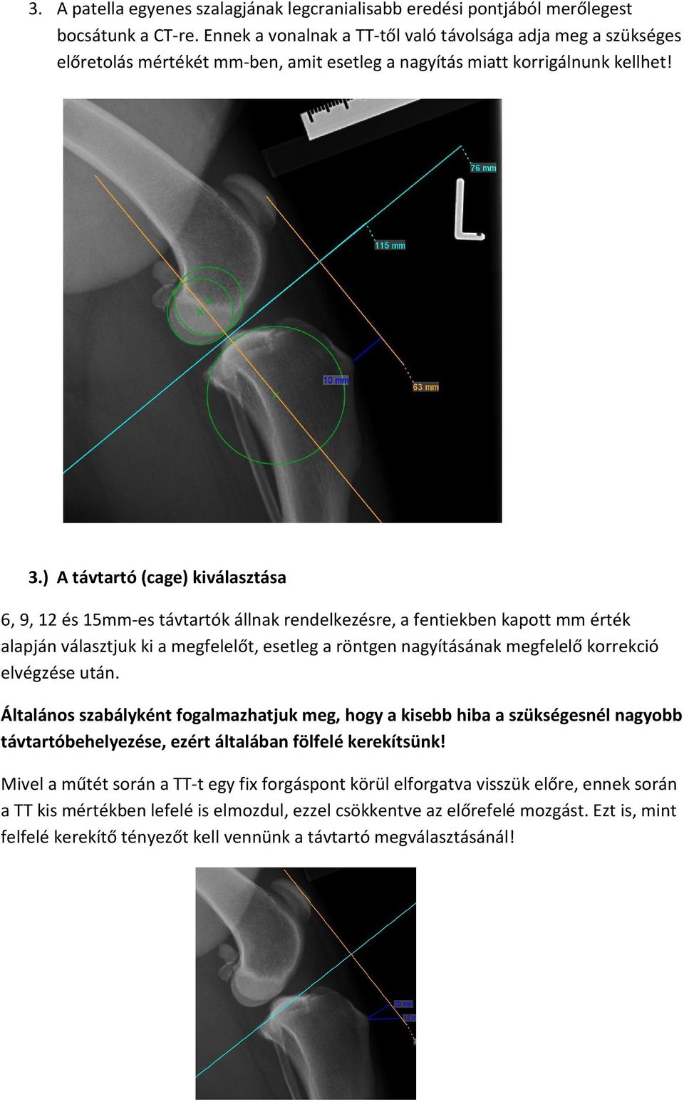 ) A távtartó (cage) kiválasztása 6, 9, 12 és 15mm-es távtartók állnak rendelkezésre, a fentiekben kapott mm érték alapján választjuk ki a megfelelőt, esetleg a röntgen nagyításának megfelelő