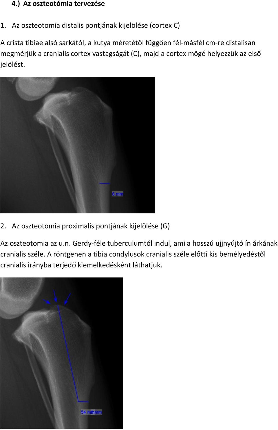 distalisan megmérjük a cranialis cortex vastagságát (C), majd a cortex mögé helyezzük az első jelölést. 2.