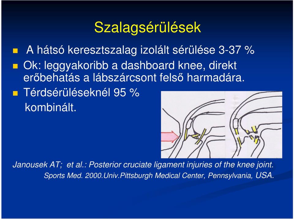 Térdsérüléseknél 95 % kombinált. Janousek AT; et al.