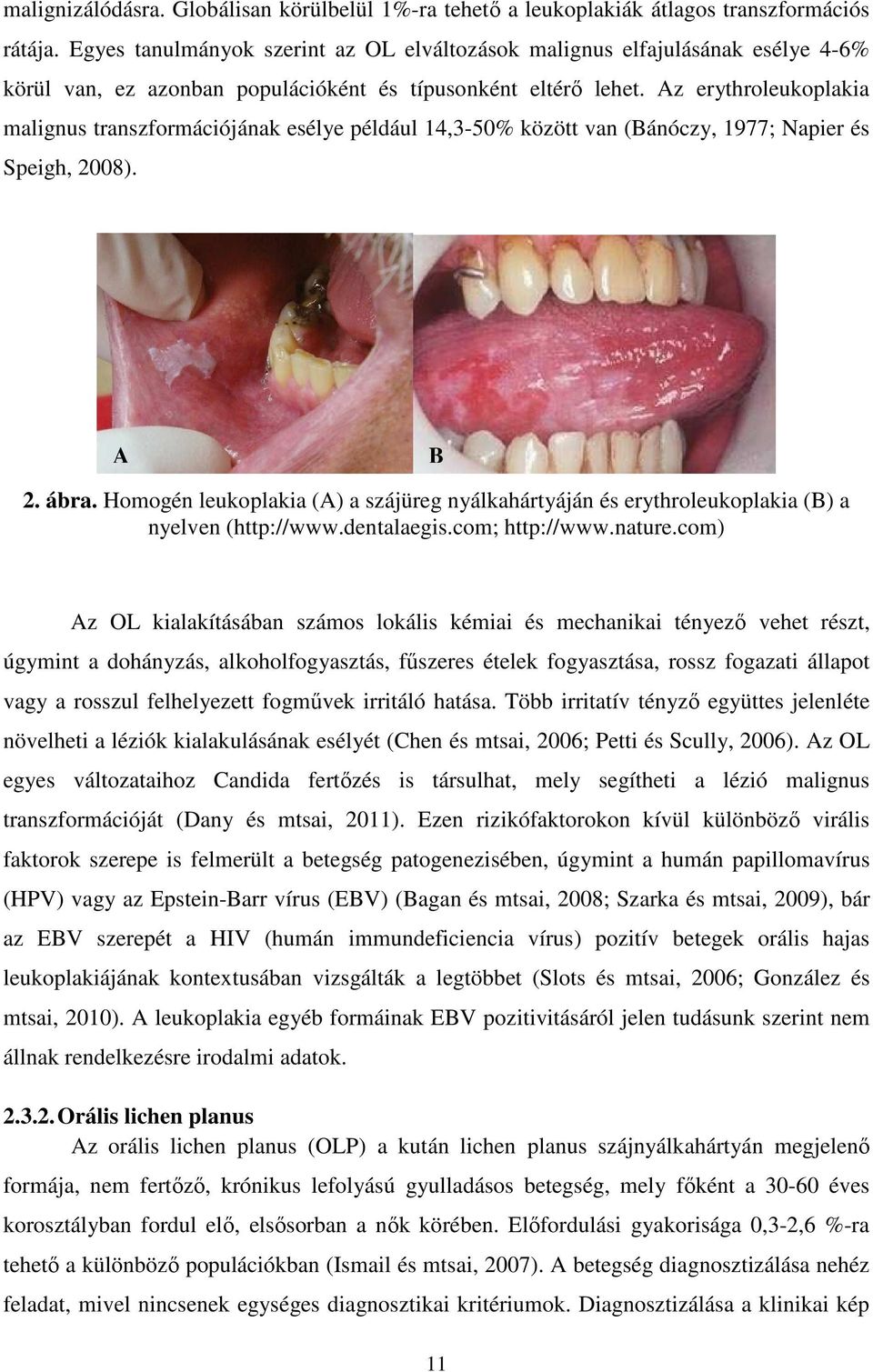 Az erythroleukoplakia malignus transzformációjának esélye például 14,3-50% között van (Bánóczy, 1977; Napier és Speigh, 2008). A B 2. ábra.