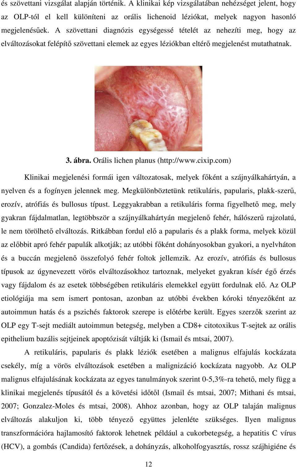 Orális lichen planus (http://www.cixip.com) Klinikai megjelenési formái igen változatosak, melyek főként a szájnyálkahártyán, a nyelven és a fogínyen jelennek meg.