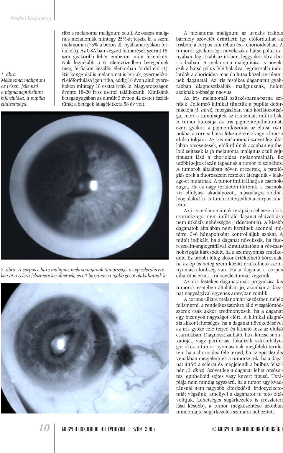 A szem melanoma: az íriszen és a retinán, a csilló testen