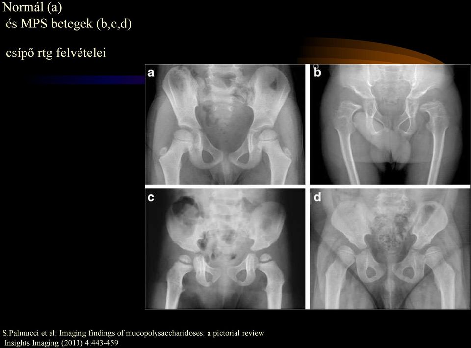 Palmucci et al: Imaging findings of