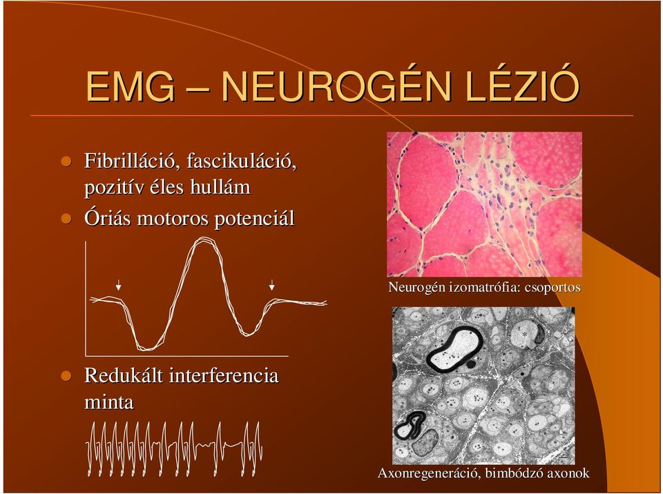 potenciál Neurogén izomatrófia: csoportos Redukált