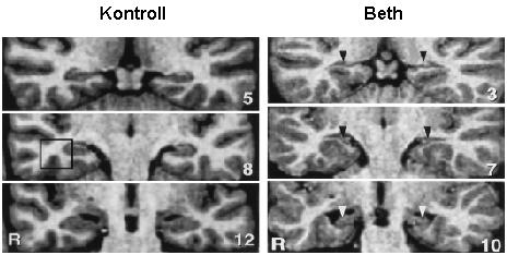 MRI eredmények Bilaterális hippocampus-károsodás Csökkent