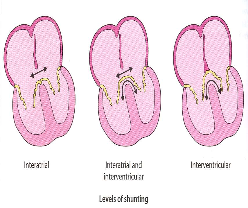 Atrioventricularis Septum Defectus Mitralis elülső vitorla (cleft)!