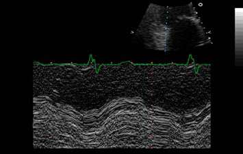 Myocardialis teljesítmény index (Tei index) Értékes információt nyújt a bal kamra systoles és diastoles funkcióját illetően Nem befolyásolja: a bal kamrai geometria (pl.