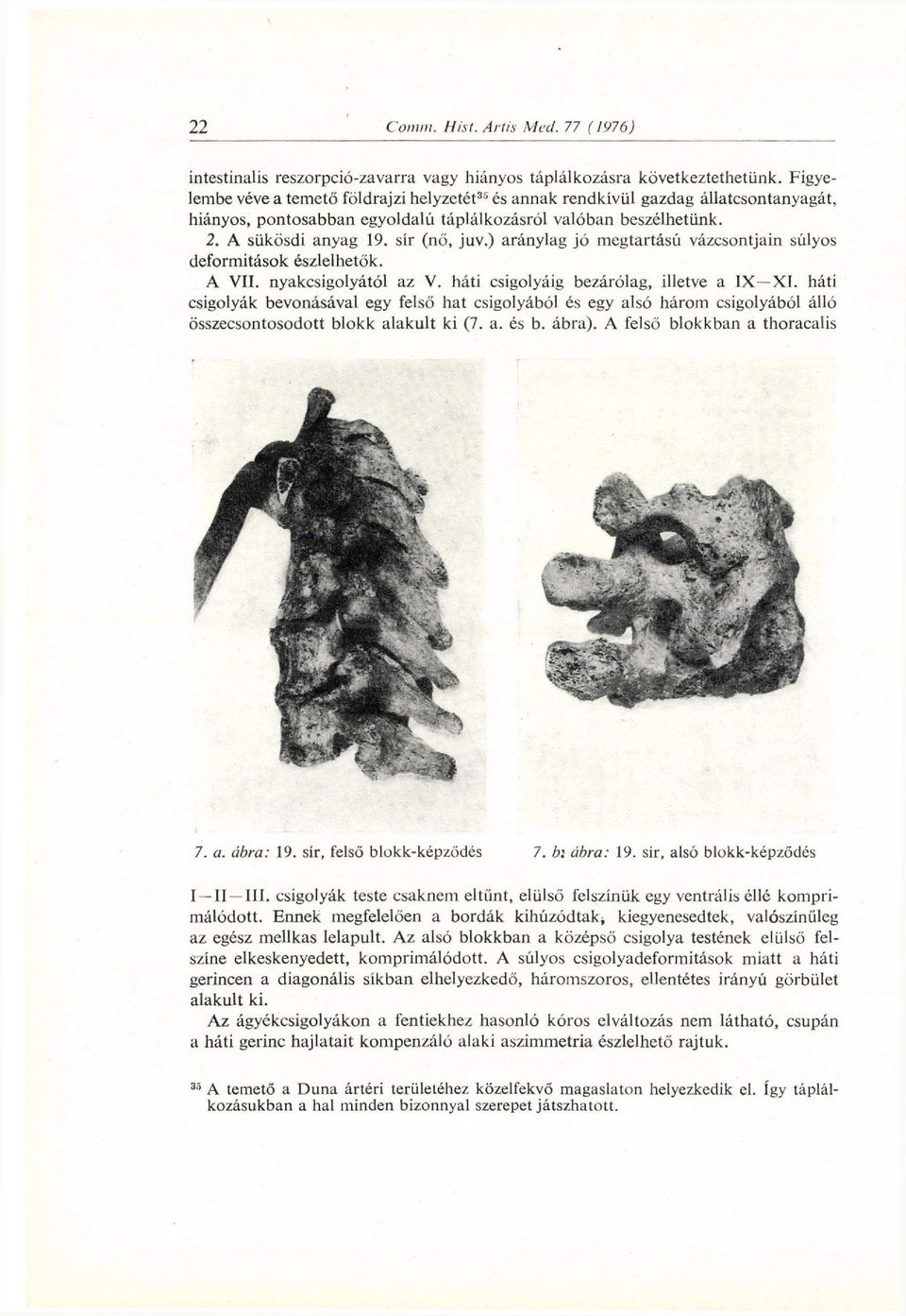 ) aránylag jó megtartású vázcsontjain súlyos deformitások észlelhetők. A VII. nyakcsigolyától az V. háti csigolyáig bezárólag, illetve a IX XI.