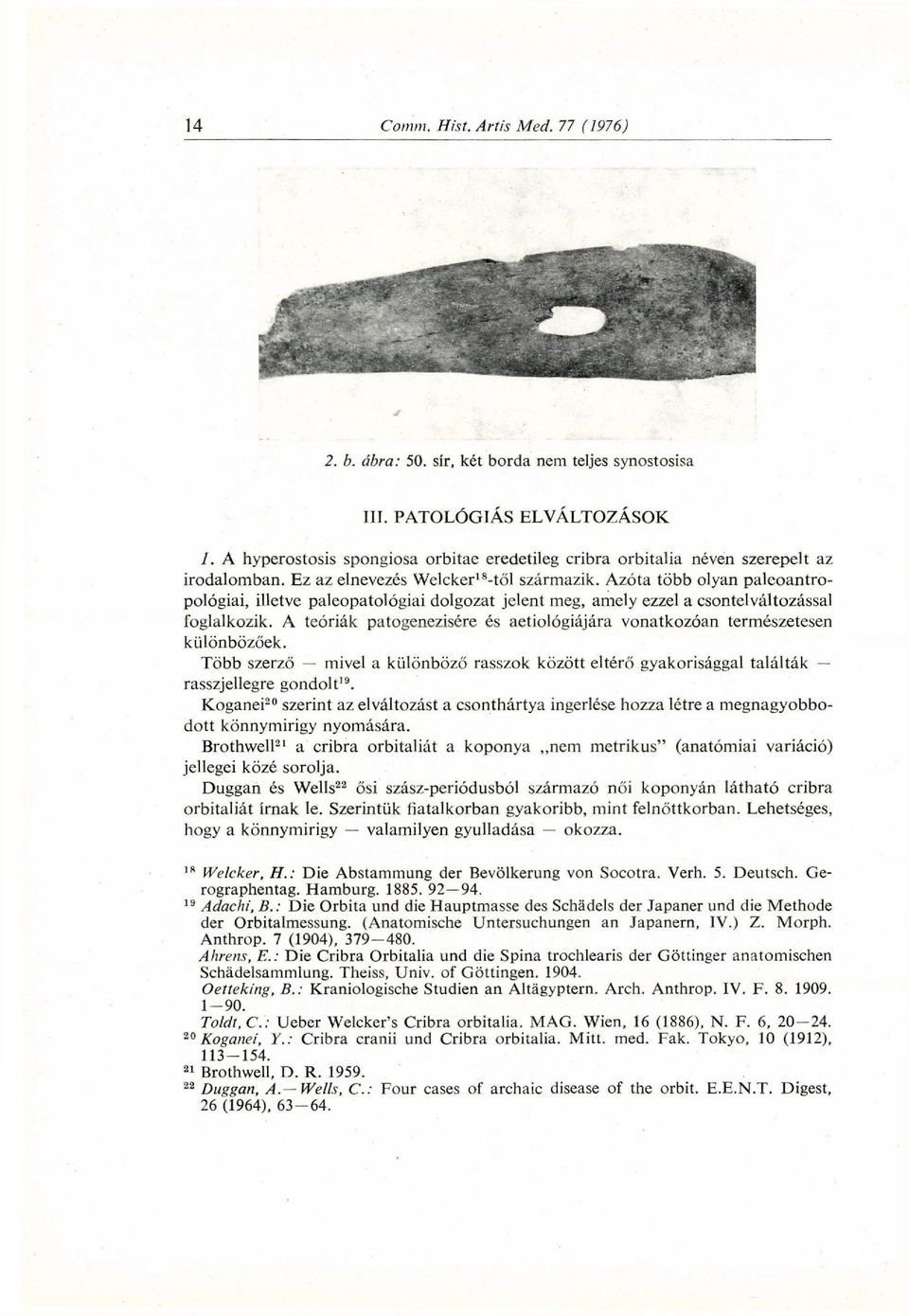 A teóriák patogenezisére és aetiológiájára vonatkozóan természetesen különbözőek. Több szerző mivel a különböző rasszok között eltérő gyakorisággal találták rasszjellegre gondolt 19.