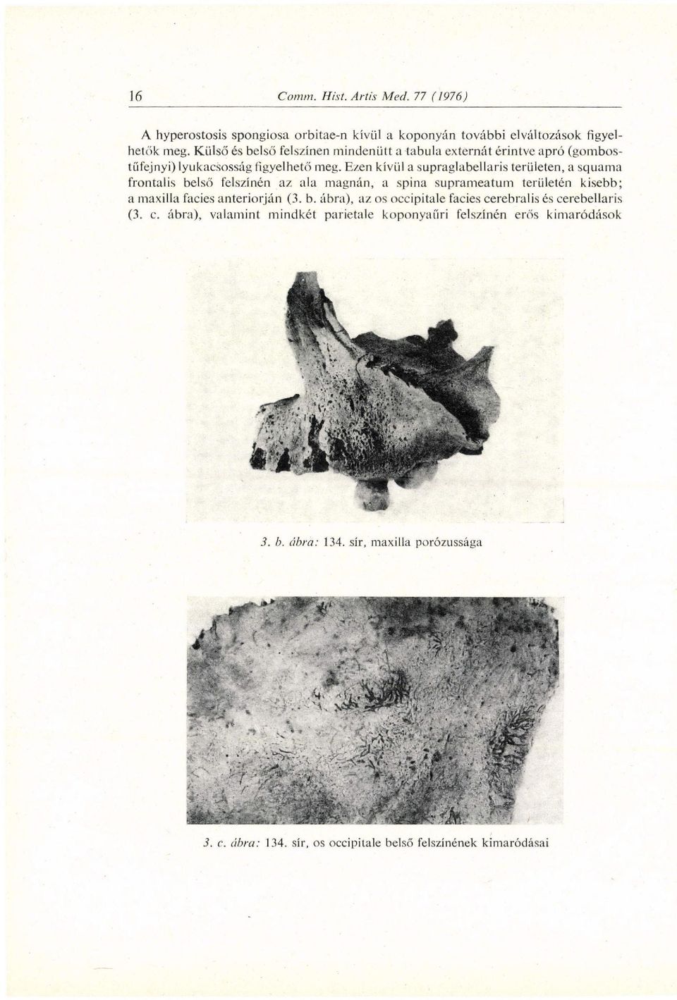 Ezen kívül a supraglabellaris területen, a squama frontalis belső felszínén az ala magnán, a spina suprameatum területén kisebb; a maxilla faciès