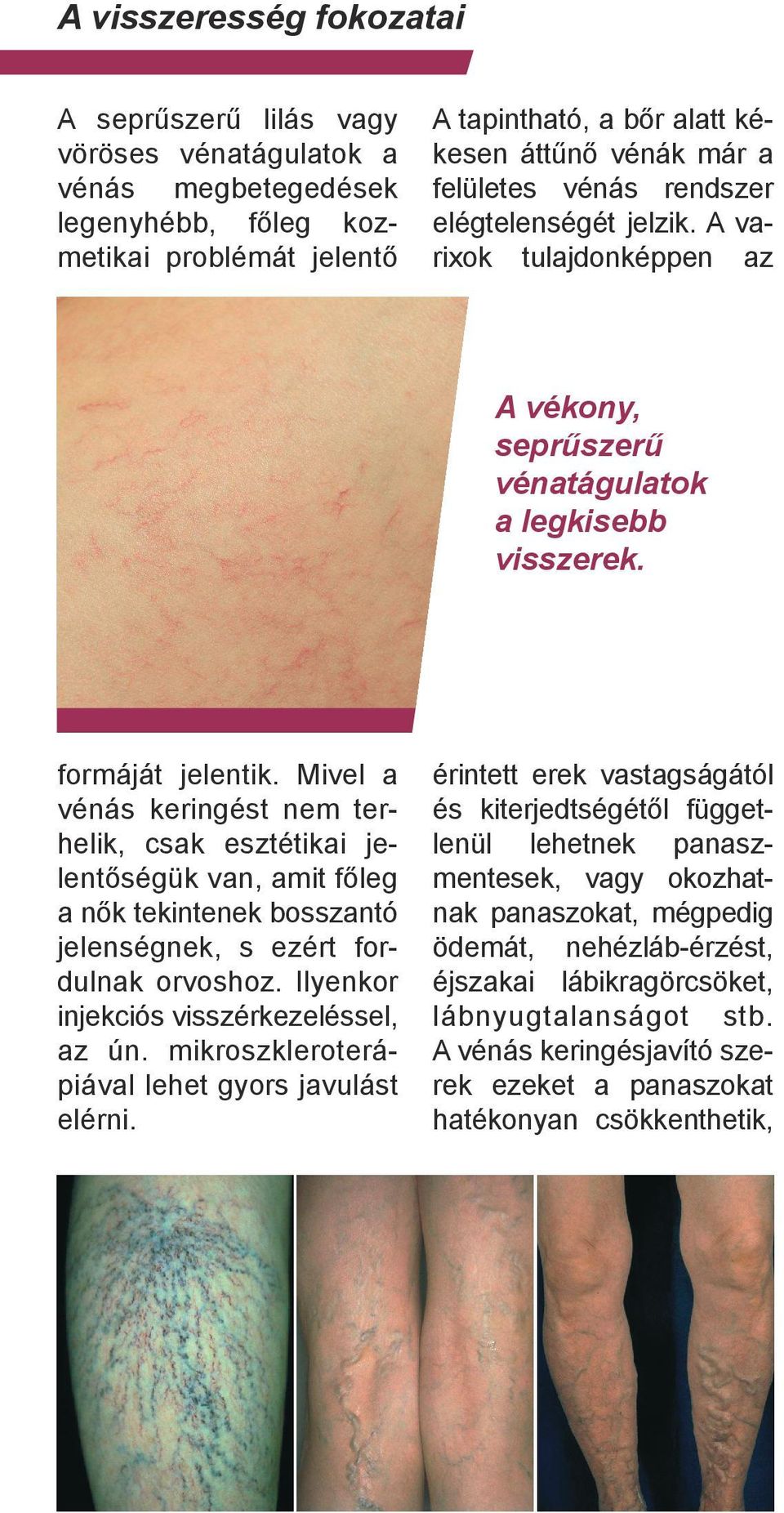 Mivel a vénás keringést nem terhelik, csak esztétikai jelentőségük van, amit főleg a nők tekintenek bosszantó jelenségnek, s ezért fordulnak orvoshoz. Ilyenkor injekciós visszérkezeléssel, az ún.