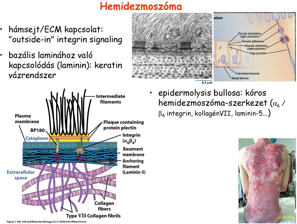 vázrendszer Hemidezmoszóma epidermolysis bullosa: kóros