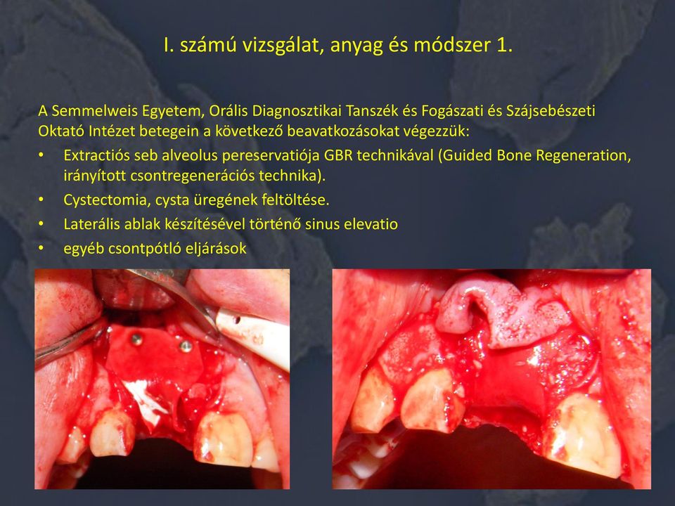 a következő beavatkozásokat végezzük: Extractiós seb alveolus pereservatiója GBR technikával (Guided Bone