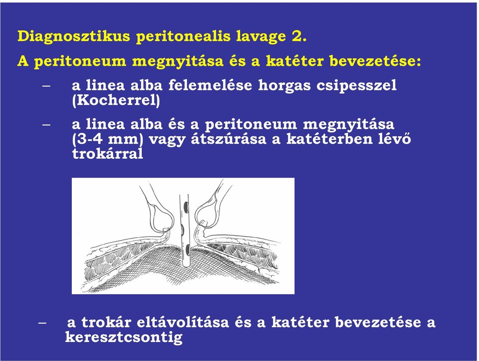 horgas csipesszel (Kocherrel) a lineaalbaés a peritoneummegnyitása (3-4