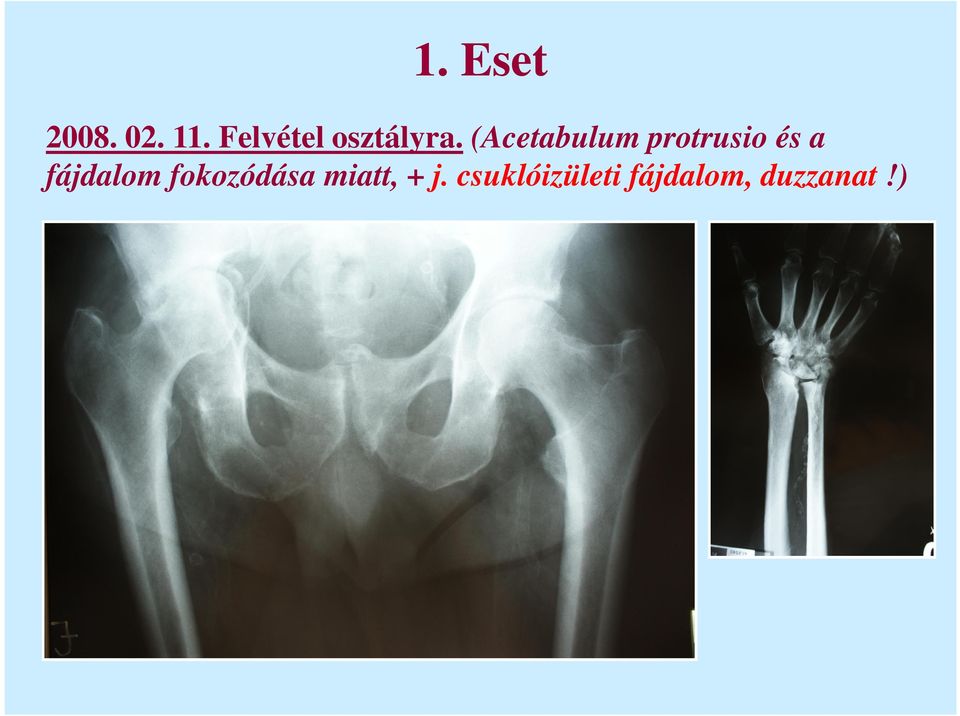 (Acetabulum protrusio és a