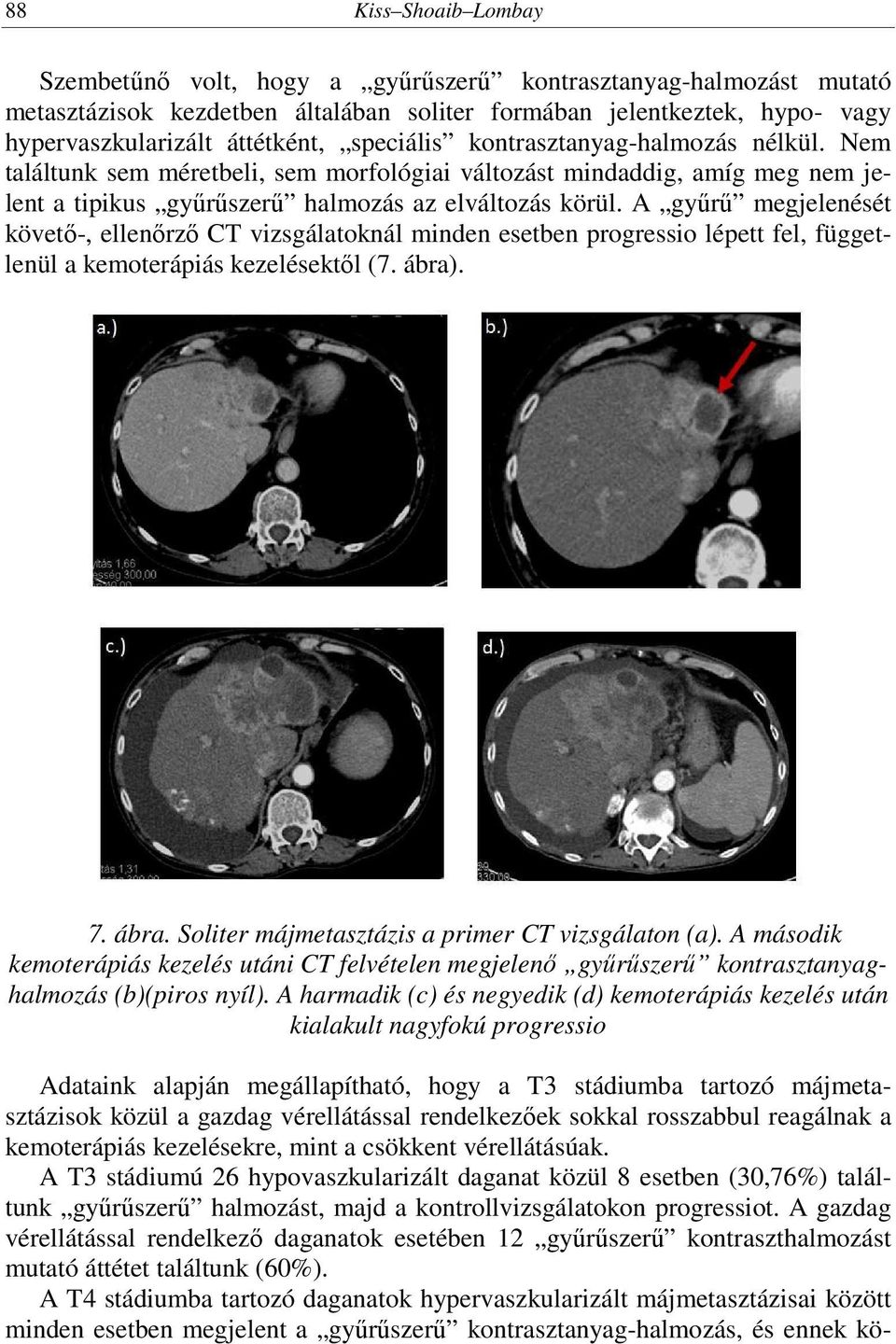 A gyűrű megjelenését követő-, ellenőrző CT vizsgálatoknál minden esetben progressio lépett fel, függetlenül a kemoterápiás kezelésektől (7. ábra).