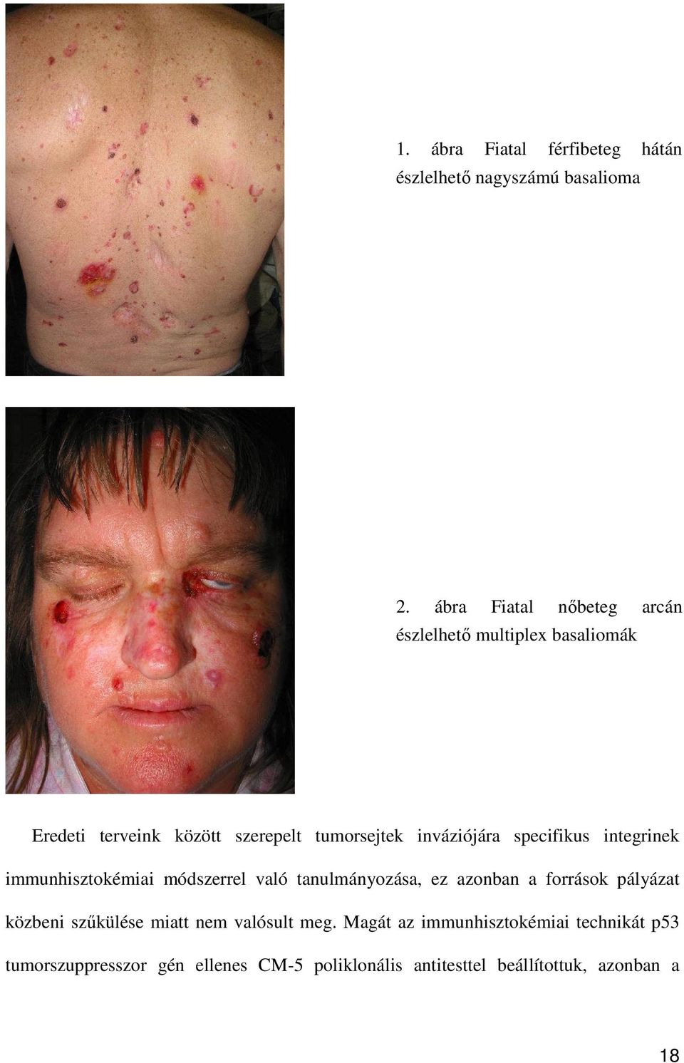 inváziójára specifikus integrinek immunhisztokémiai módszerrel való tanulmányozása, ez azonban a források
