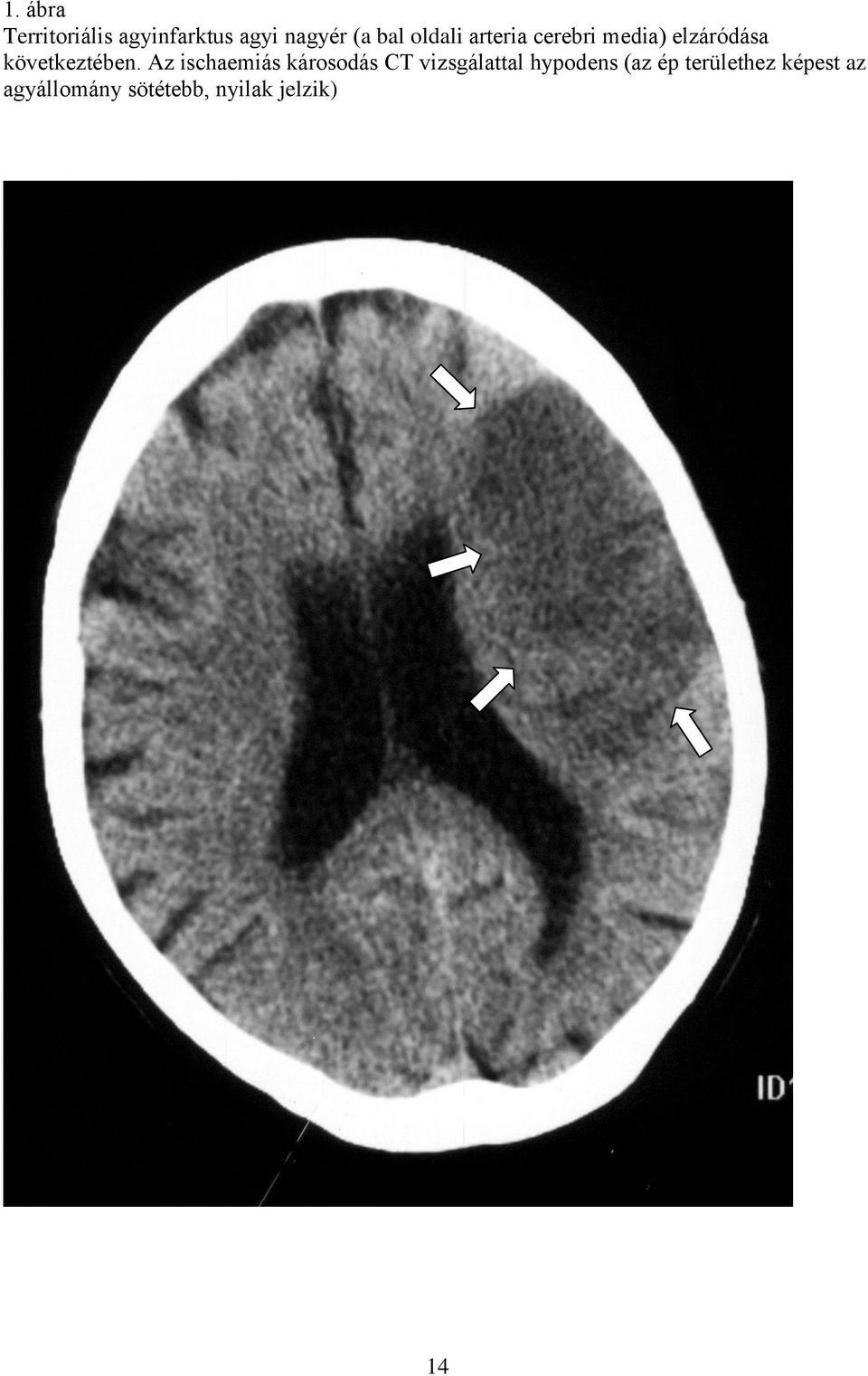 Az ischaemiás károsodás CT vizsgálattal hypodens (az ép