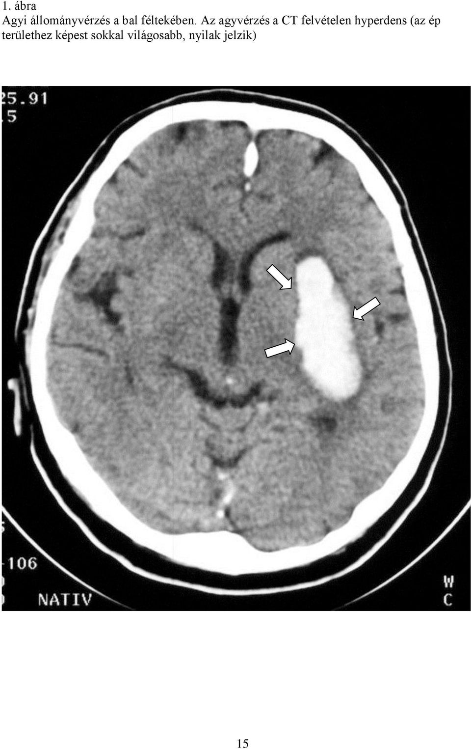 Az agyvérzés a CT felvételen