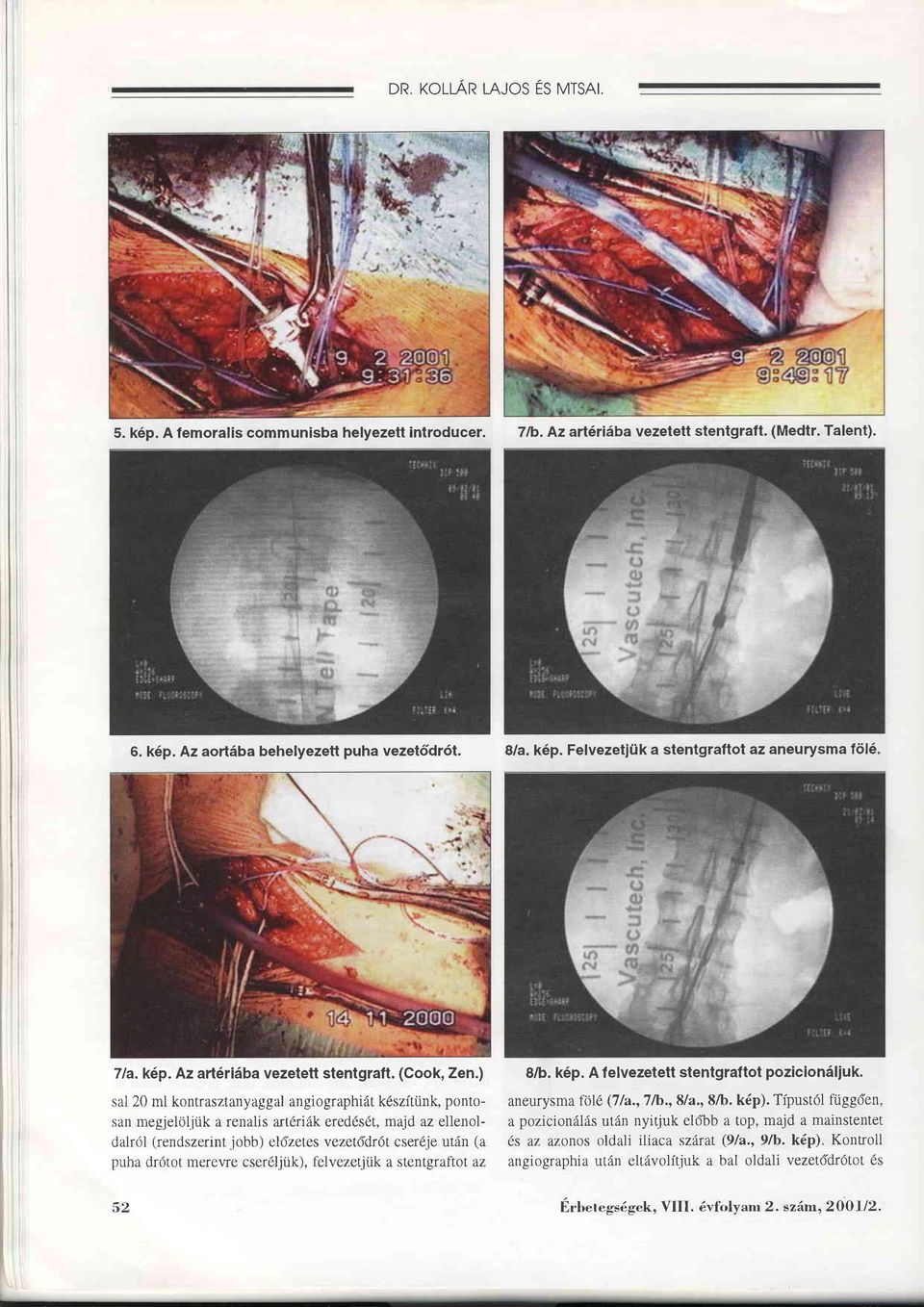 jük a renalis art6riäk eredds6t, majd az ellenoldalröl (rendszerint iobb) eldzetes vezetddr1t cserdje utän (a puha drdtot merevre cserdljük), felvezetjük a stentgraftot äz 8/b. k6p.