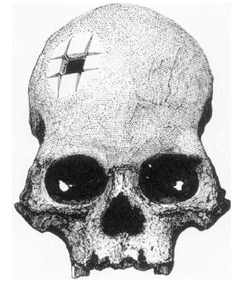 4. SEBÉSZI TREPANÁCIÓ 4.1.