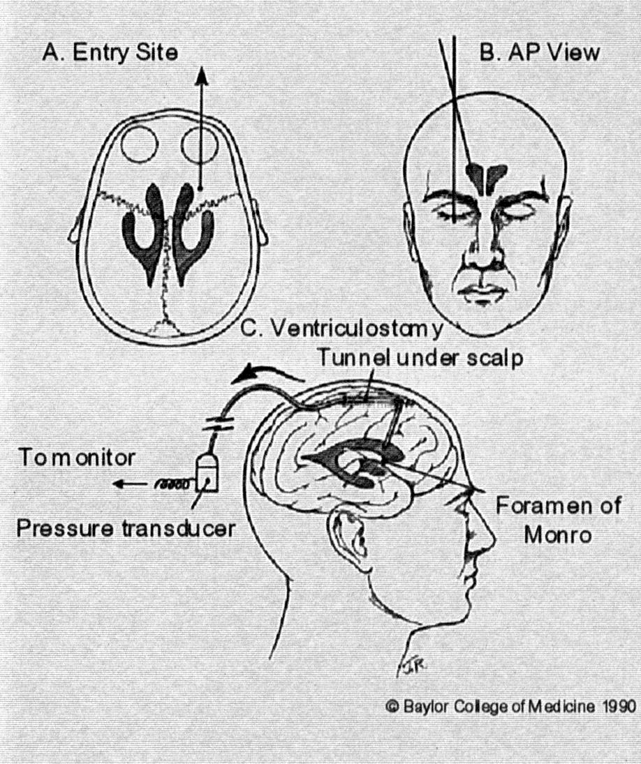 Intracranialis nyomás