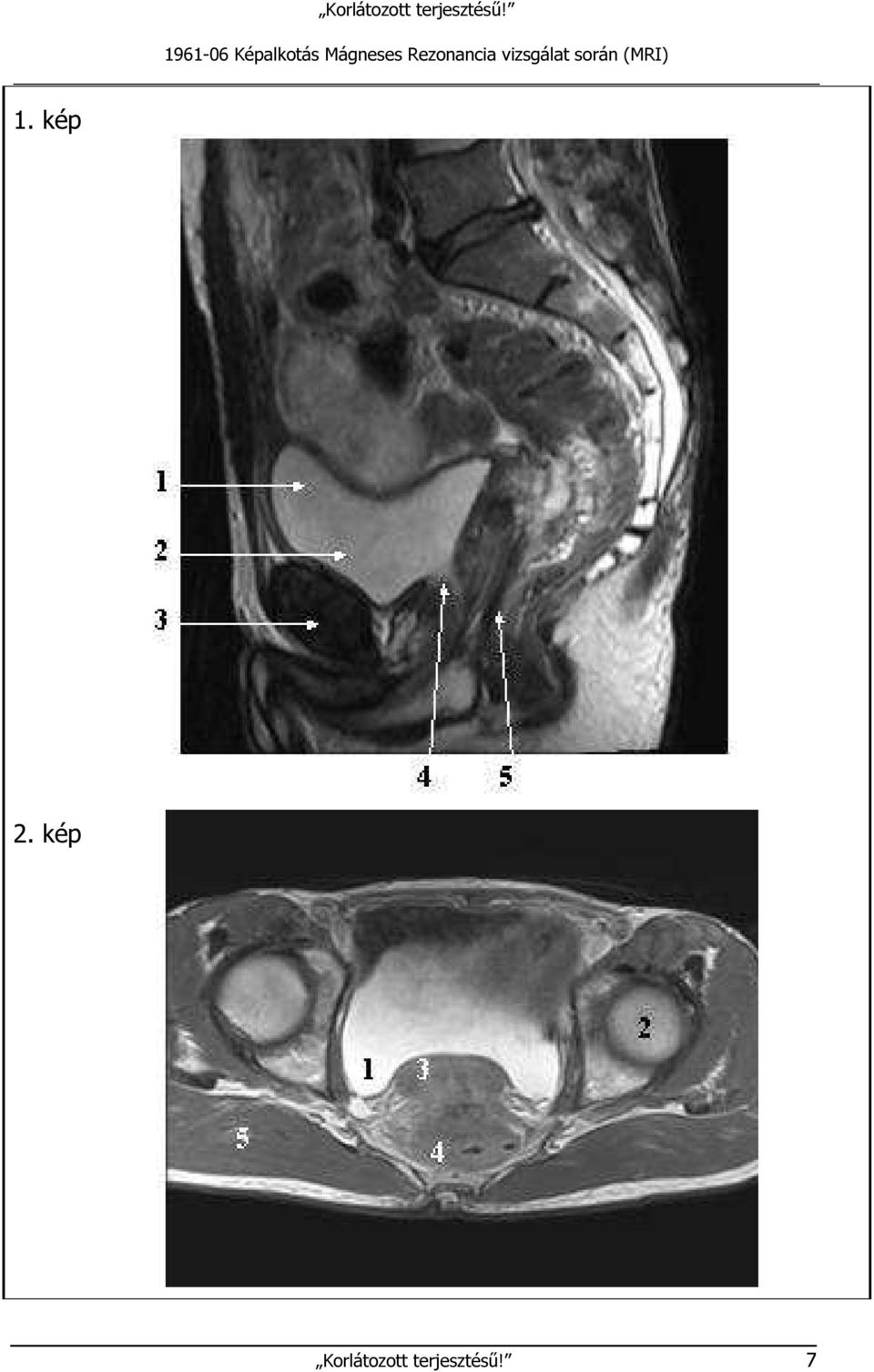 vizsgálat során (MRI).