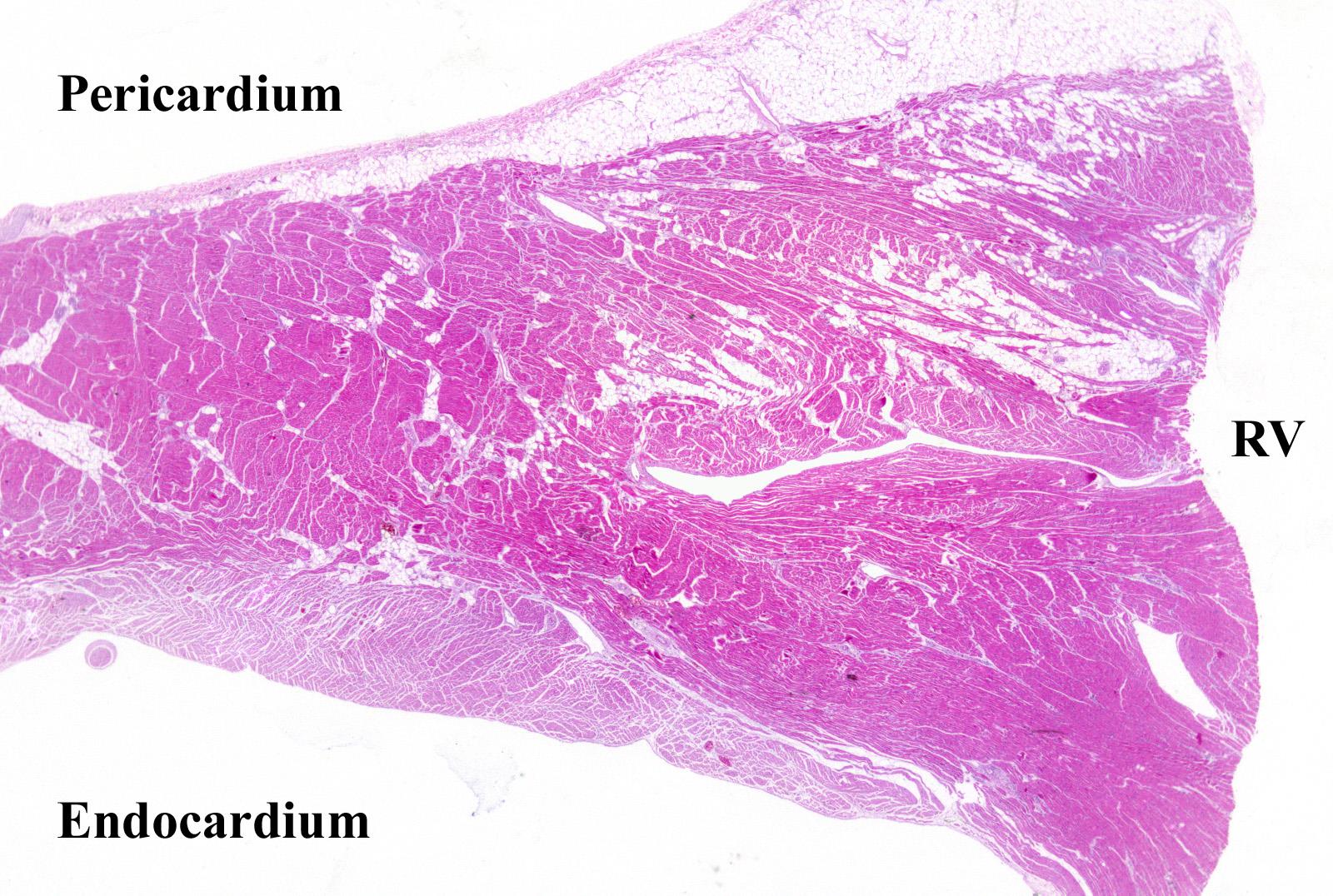 Arrhythmogen jobb kamrai CM: a JK