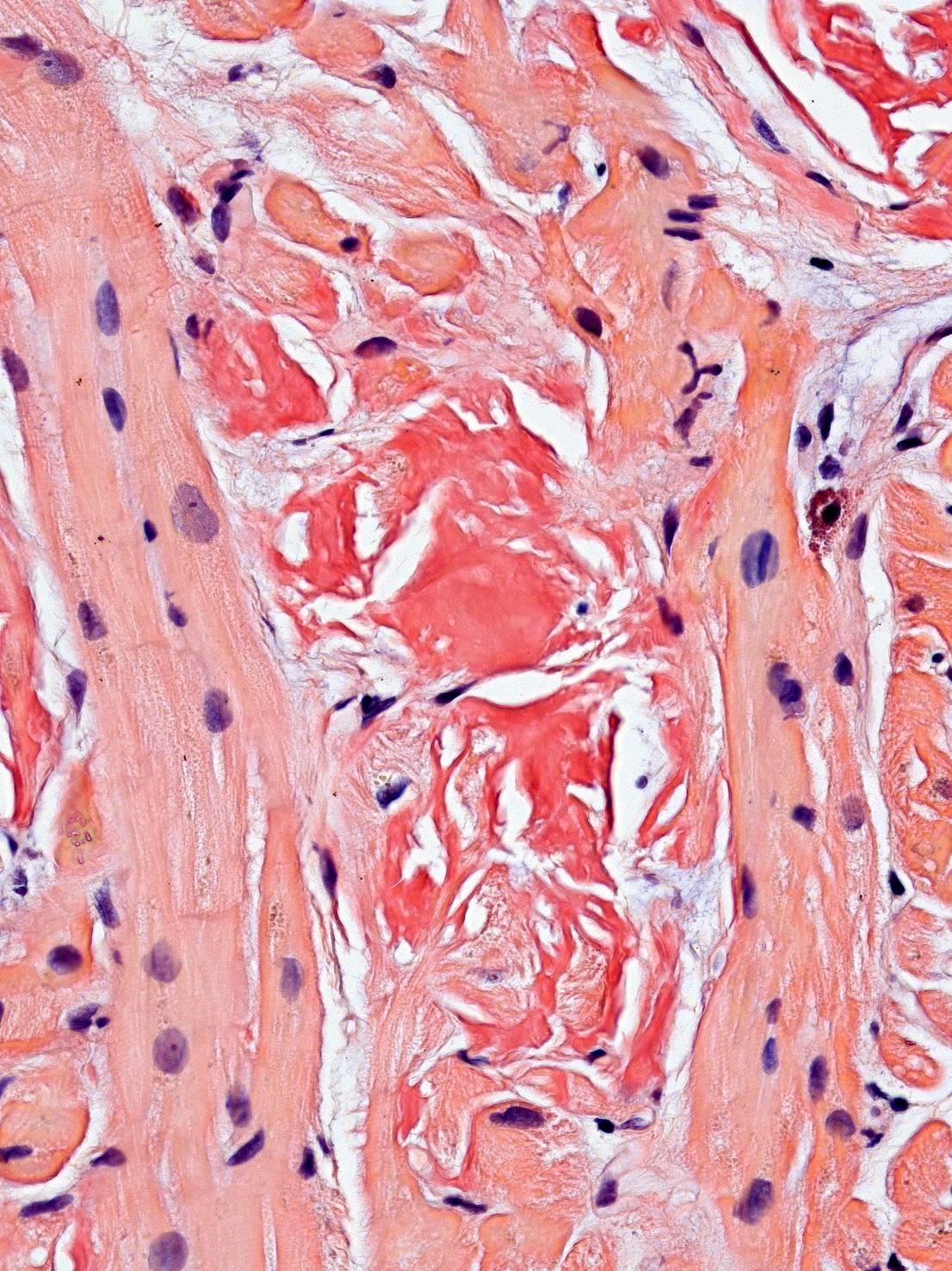 Amyloid: eosinophil,