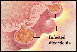 Diverticulitis pathofiziológia Divertikulum szájadék obstrukciója