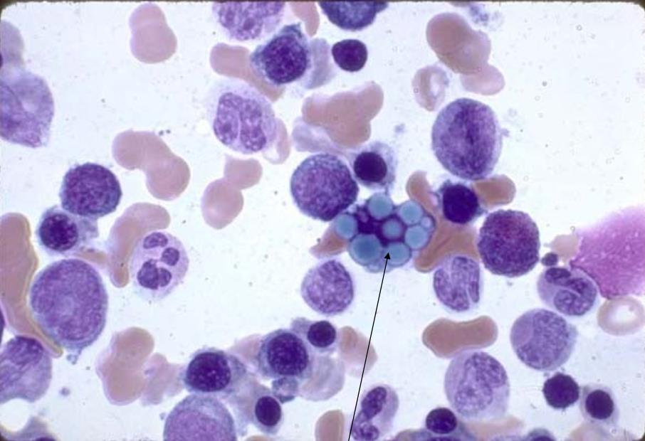 Csontvelői kép: plazmasejtek plazmasejt