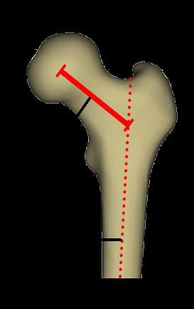 20. ábra Femoralis eltoltság A paraméter ábrázolása saját 3D modell segítségével (FE-femoralis eltoltság, FATfemur anatómiai tengely).
