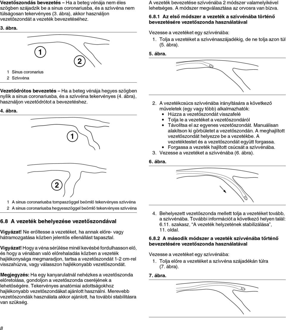 1 1 Sinus coronarius 2 Szívvéna Vezetődrótos bevezetés Ha a beteg vénája hegyes szögben nyílik a sinus coronariusba, és a szívvéna tekervényes (4. ábra), használjon vezetődrótot a bevezetéshez. 4.