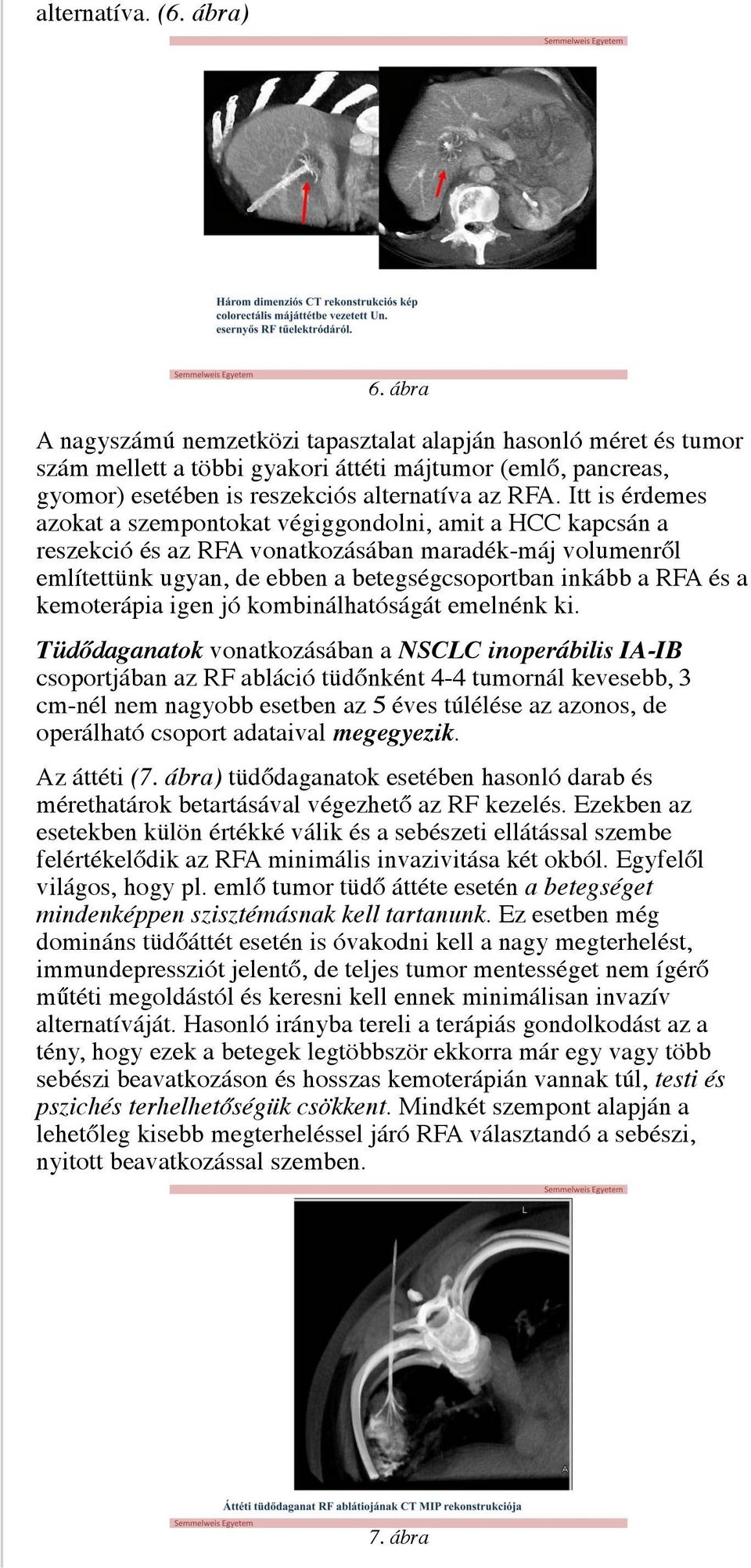 Itt is érdemes azokat a szempontokat végiggondolni, amit a HCC kapcsán a reszekció és az RFA vonatkozásában maradék-máj volumenről említettünk ugyan, de ebben a betegségcsoportban inkább a RFA és a