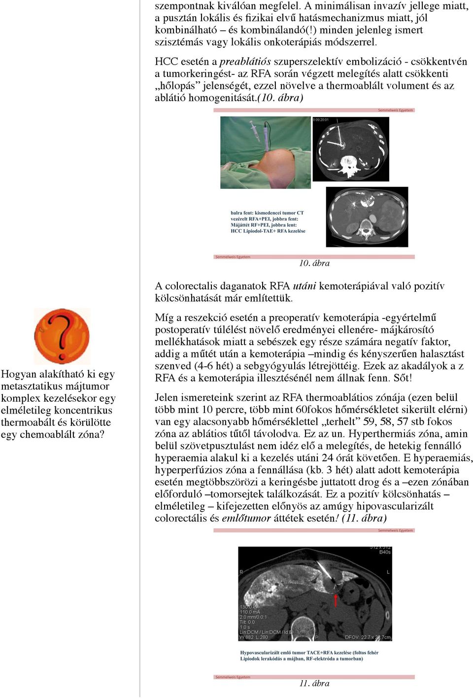 HCC esetén a preablátiós szuperszelektív embolizáció - csökkentvén a tumorkeringést- az RFA során végzett melegítés alatt csökkenti hőlopás jelenségét, ezzel növelve a thermoablált volument és az