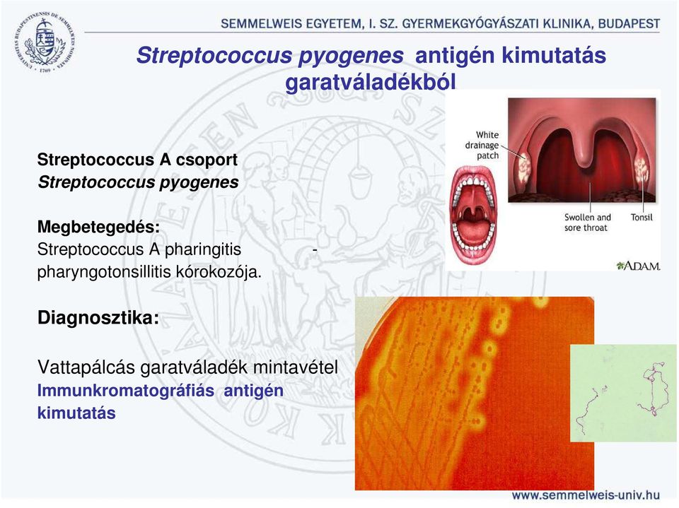 Streptococcus A pharingitis - pharyngotonsillitis kórokozója.