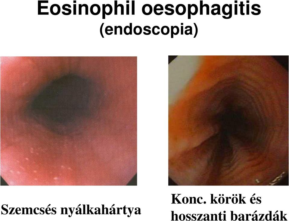 (endoscopia) Szemcsés