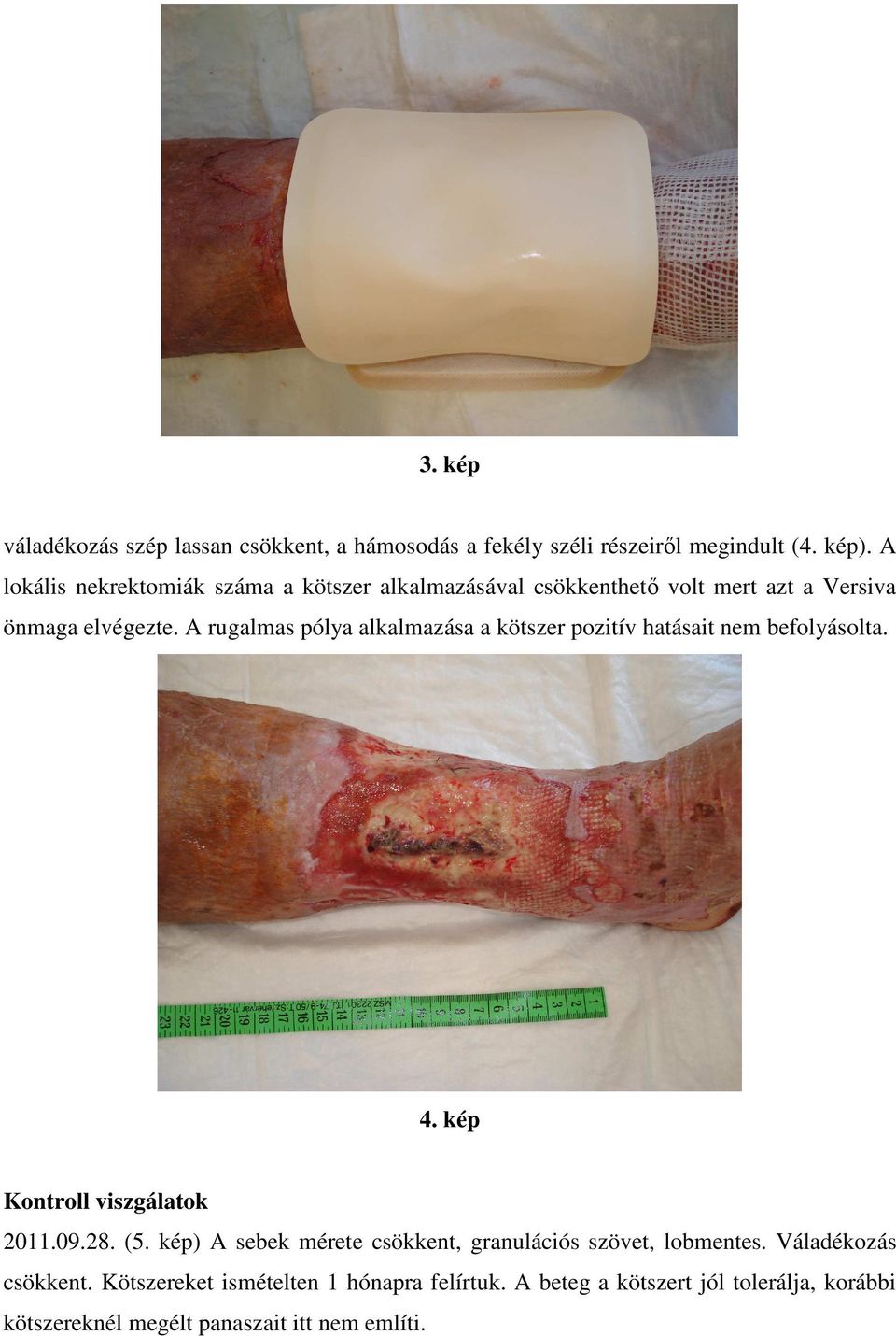 A rugalmas pólya alkalmazása a kötszer pozitív hatásait nem befolyásolta. 4. kép Kontroll viszgálatok 2011.09.28. (5.