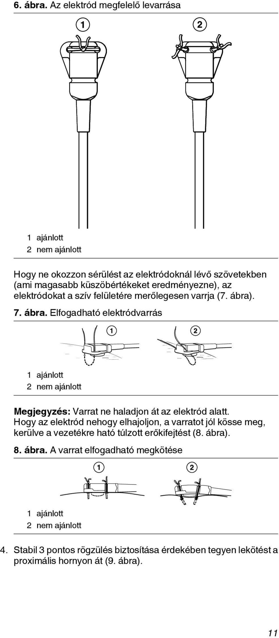 eredményezne), az elektródokat a szív felületére merőlegesen varrja (7. ábra)