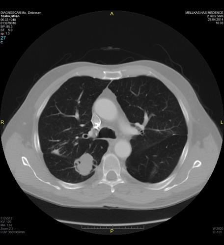 Regorafenib hatása 2014. 02.22. mellkas CT 2014. 04.